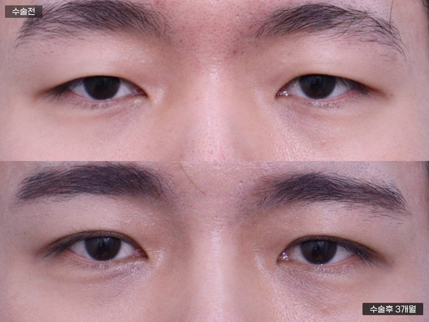 눈성형 [자연유착 쌍꺼풀 + 눈매교정]