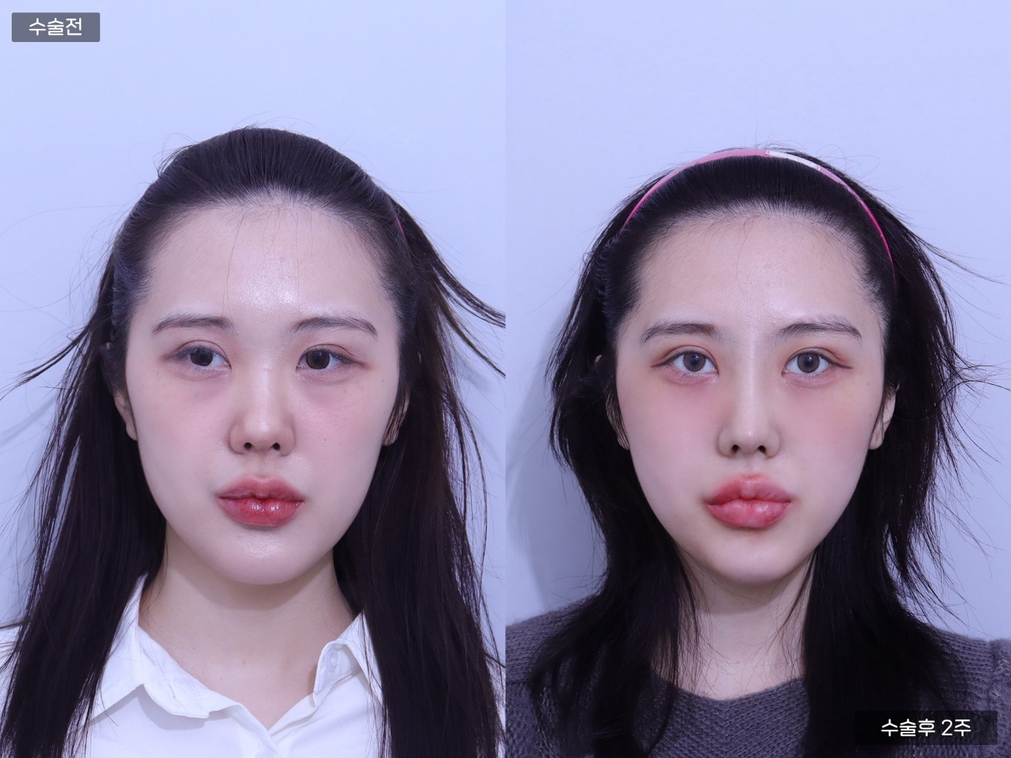 코끝교정+ 짧은코