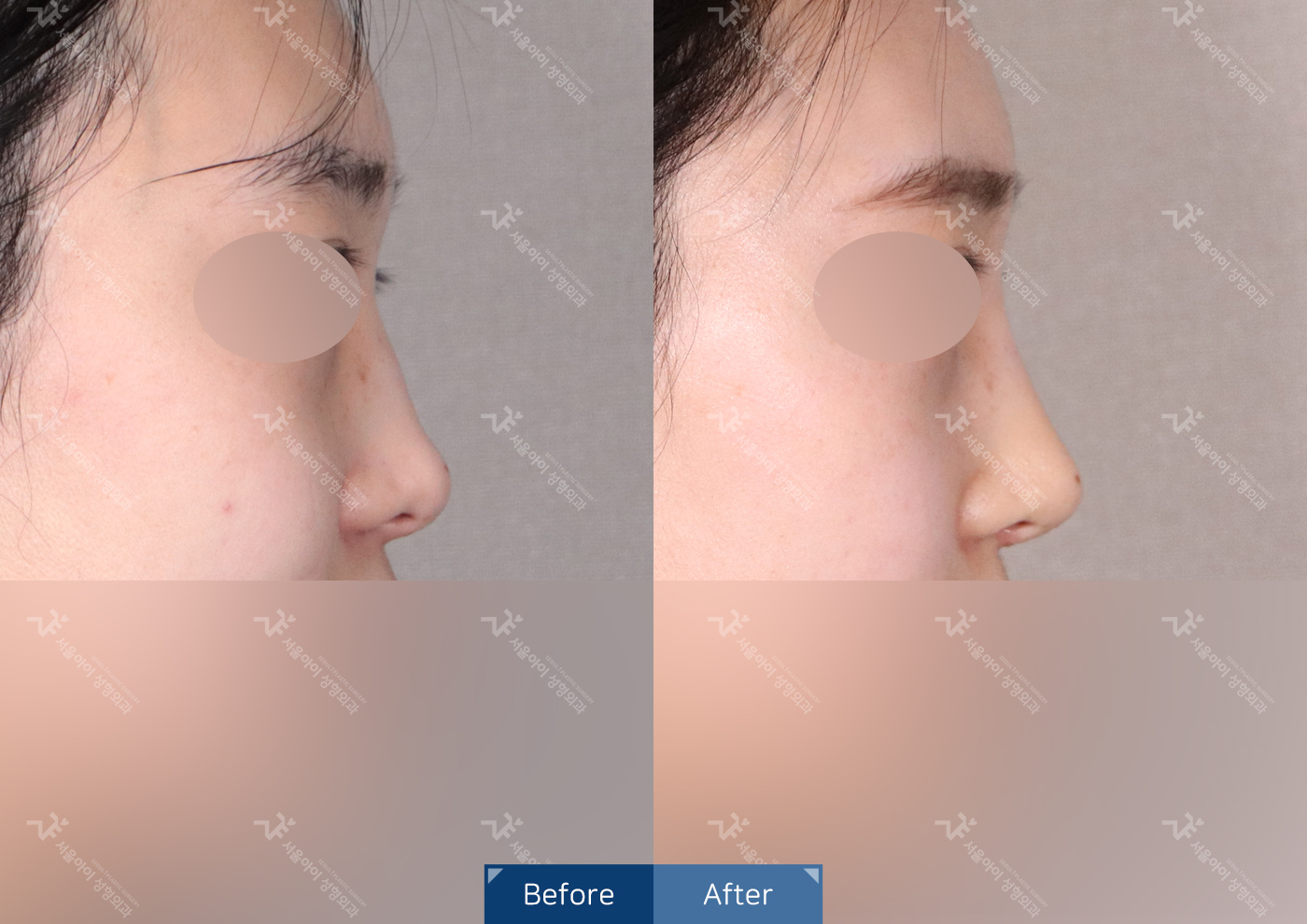 코성형[기능3종 + 미용코]