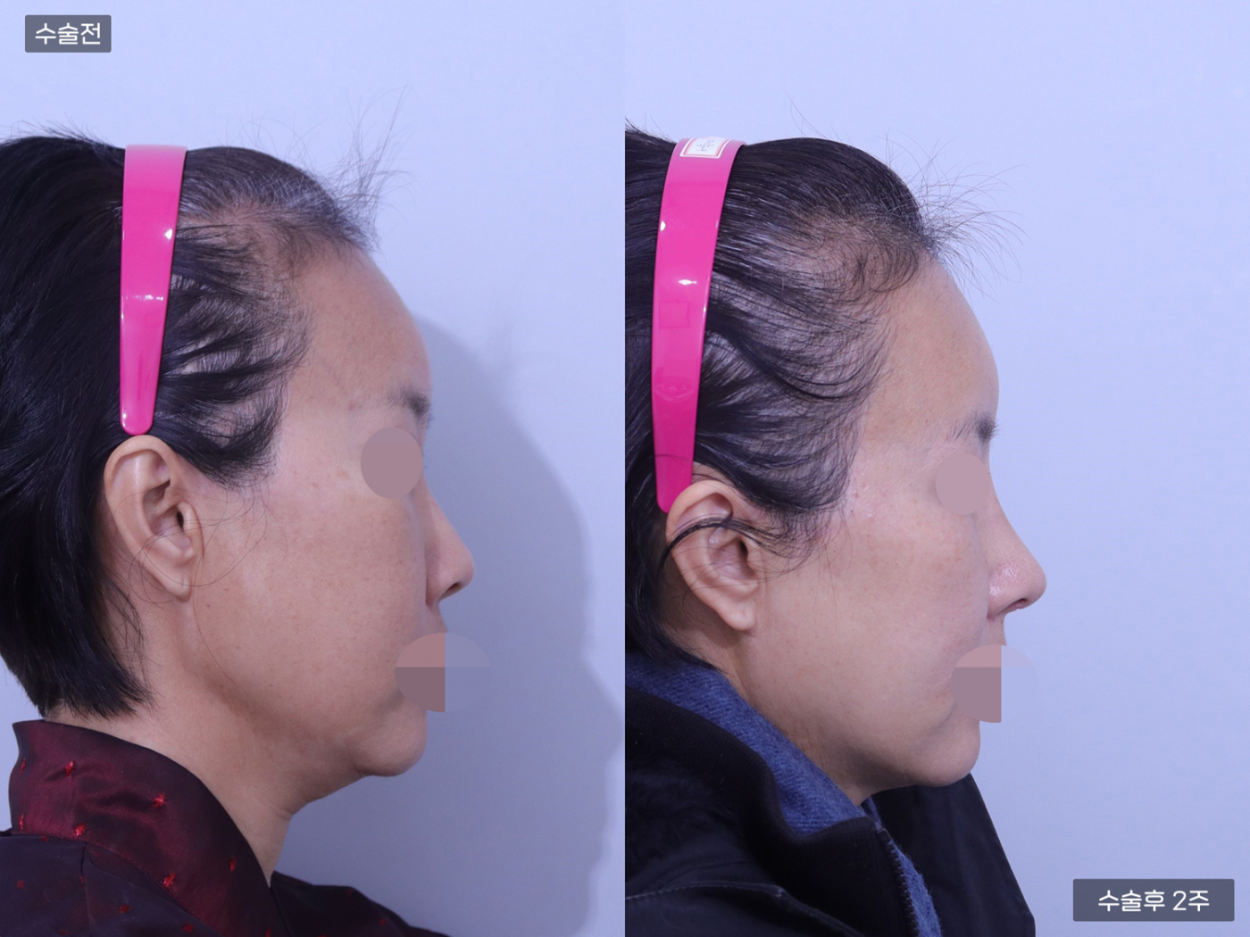 콧볼축소 + 코끝