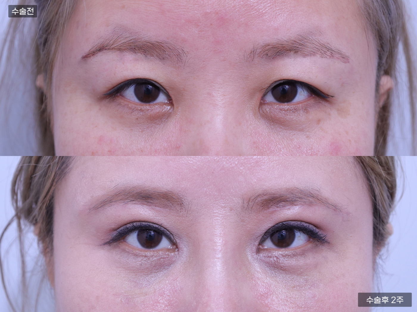 눈성형 [자연유착 쌍꺼풀 + 앞트임 + 안검하수]
