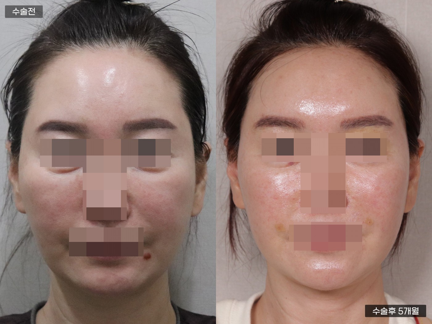 지방이식 [이마]