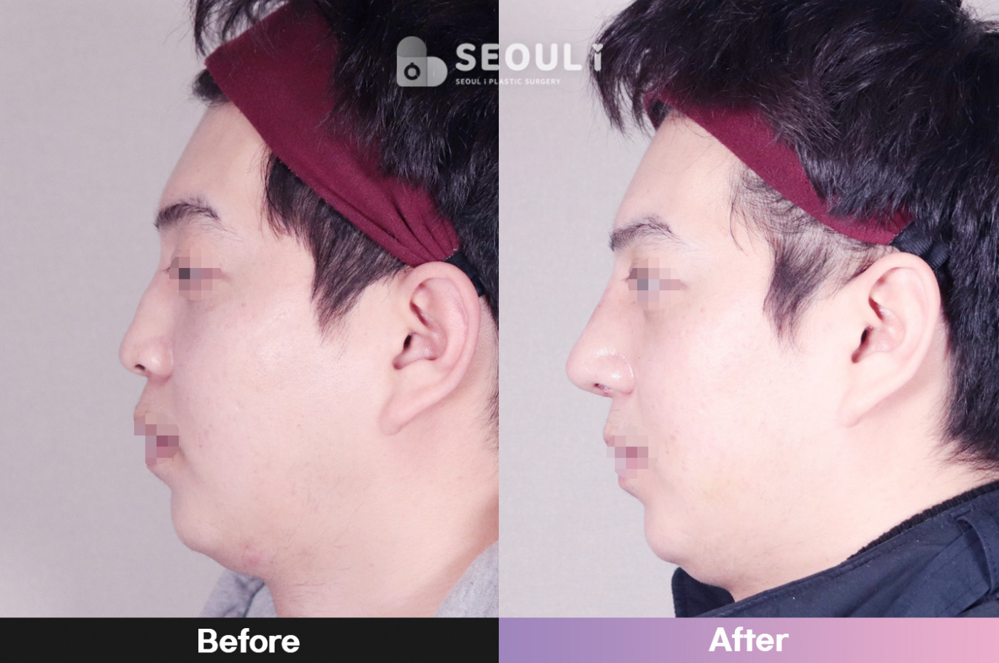 코끝(비중격) + 콧볼 축소술 + 매부리 교정