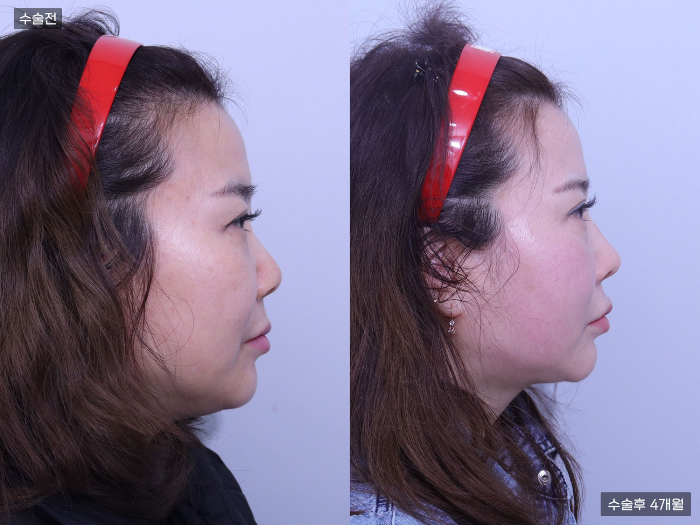 콧볼축소 + 코끝 + 복코 + 매부리코