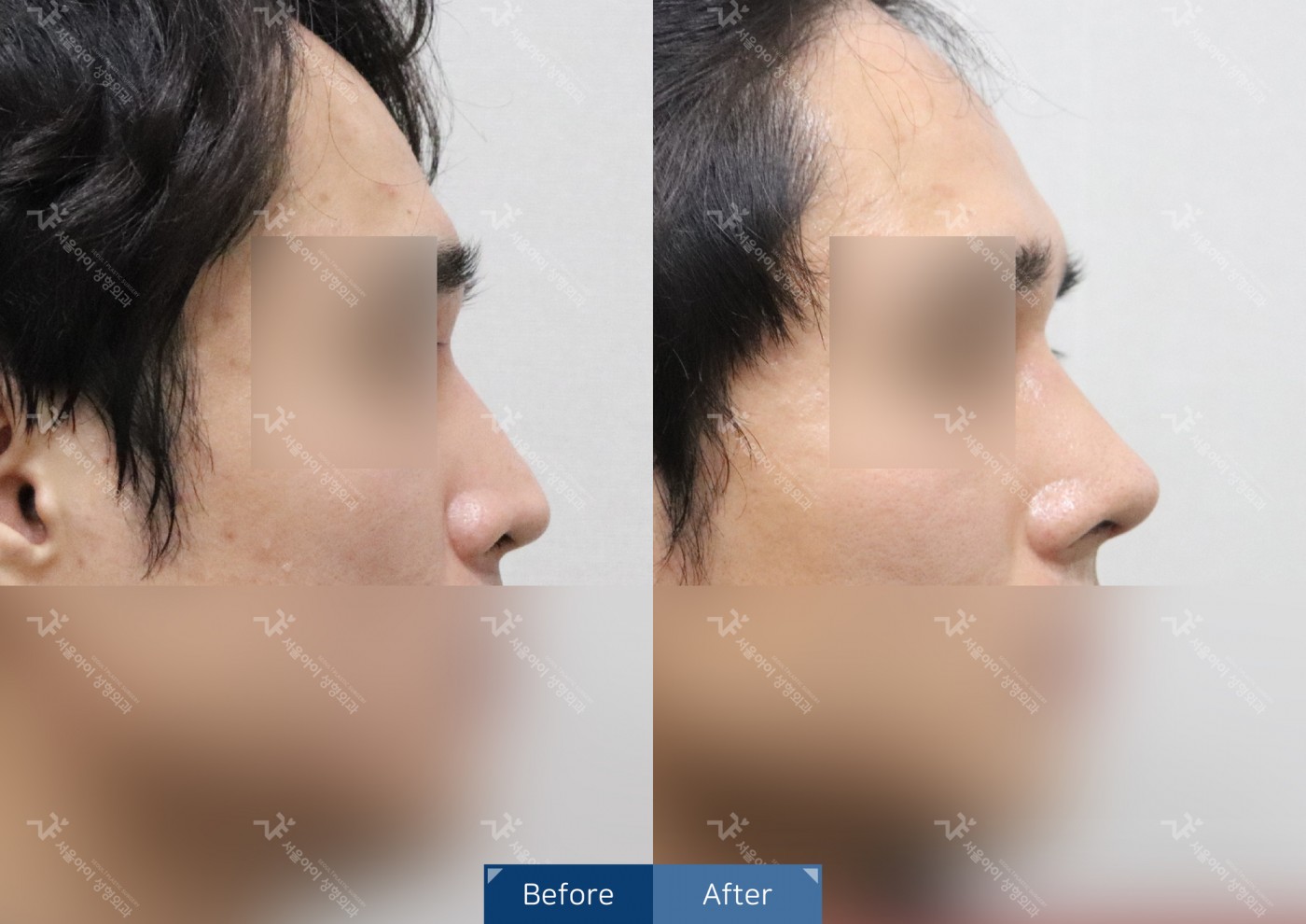 [코성형] 코끝조각술+복코교정