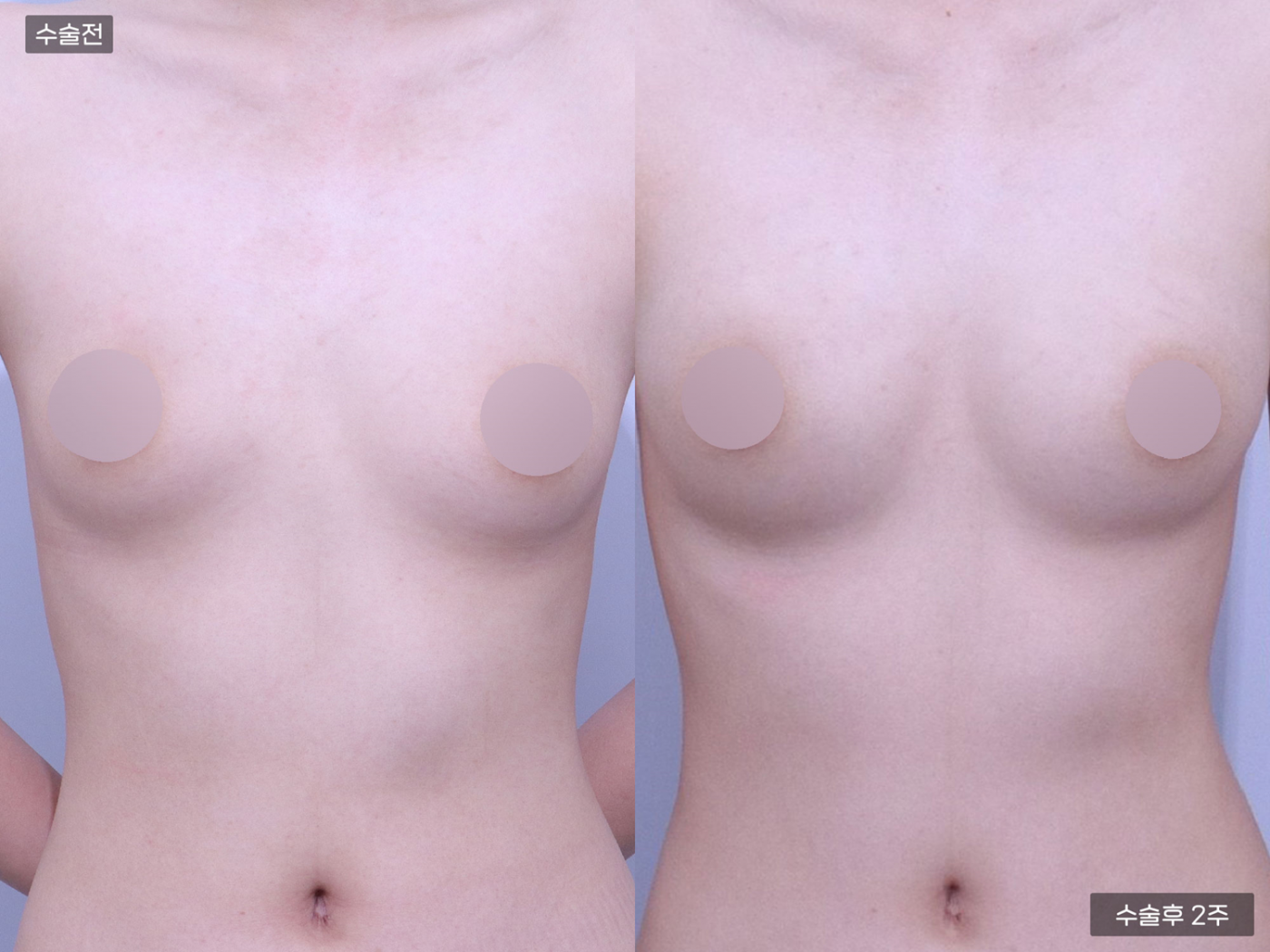 가슴성형 [가슴지방이식(250CC + 250CC)]