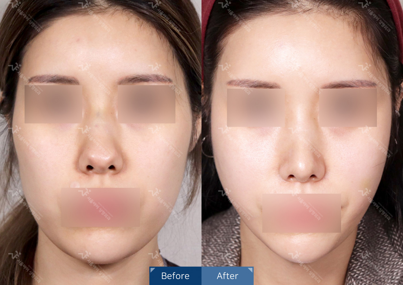 리프팅 [미니리프팅 + 사각턱보톡스]