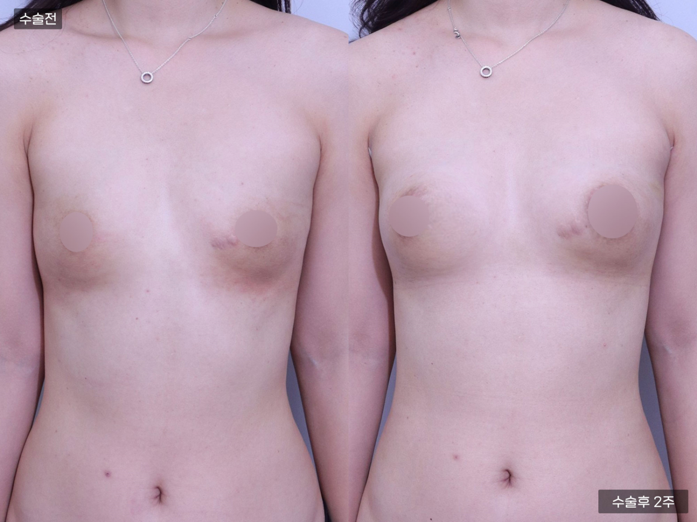 가슴성형 [가슴지방이식(200CC + 200CC)]