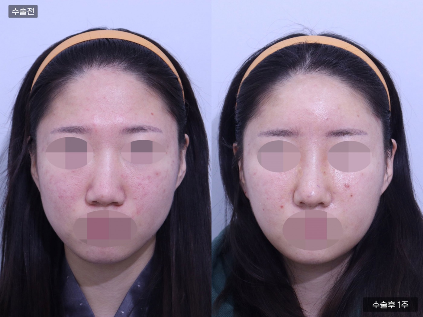 지방이식 [이마]