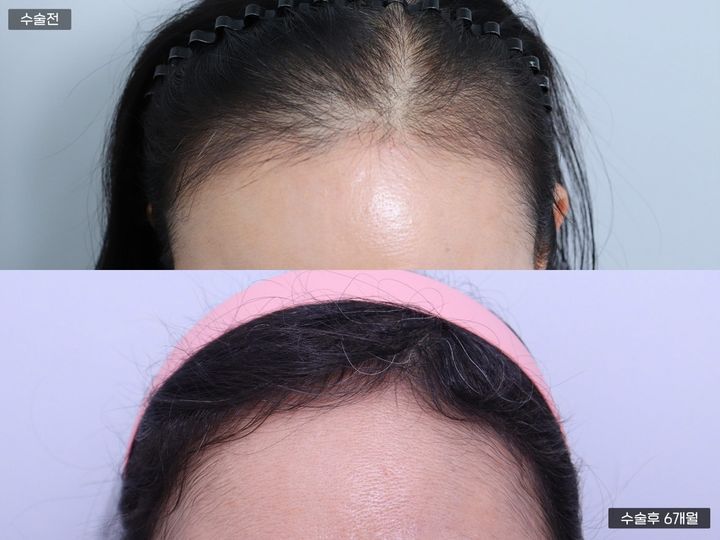 모발이식 [비절개 모발이식(3000모)]