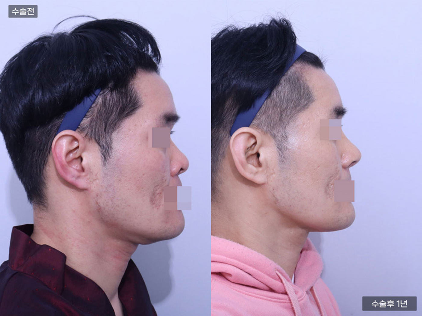 복코 + 매부리코 + 콧볼축소 + 코끝(비중격)