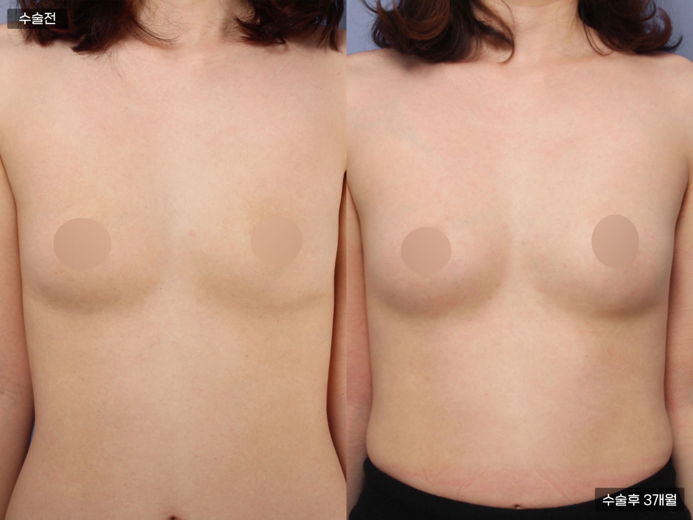 가슴성형 [가슴지방이식]