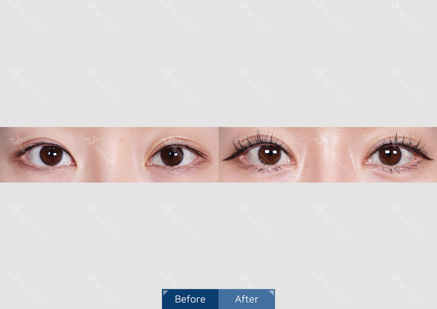눈성형 [자연유착 쌍꺼풀]