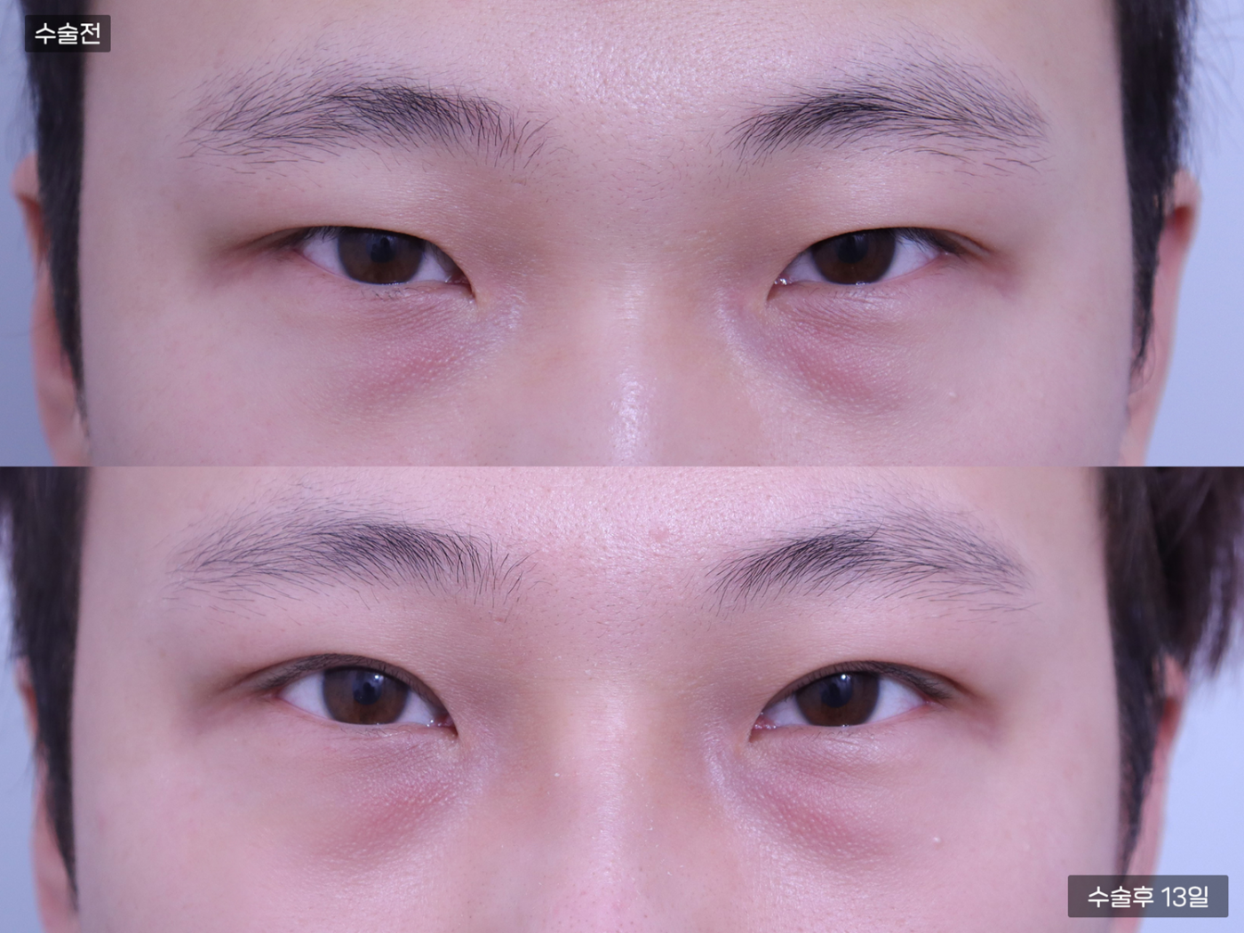 눈성형 [자연유착 쌍꺼풀]