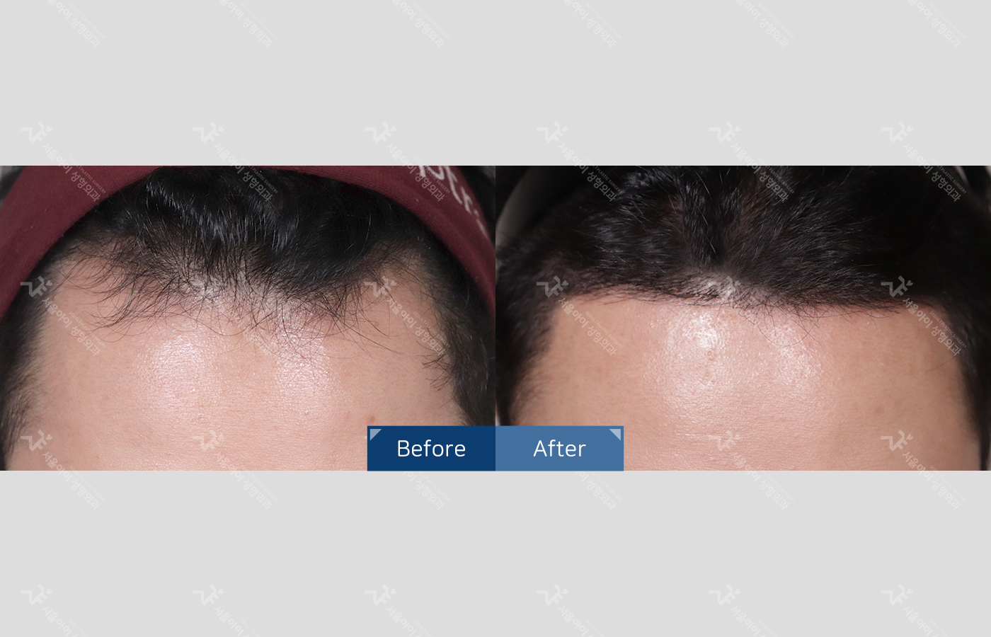 모발이식 [절개 모발이식(3000모) + 엠자 + 헤어라인]