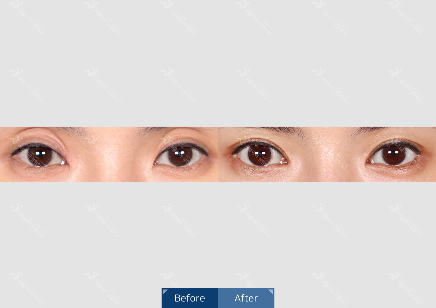 눈성형 [자연유착 쌍꺼풀 + 뒷밑트임]