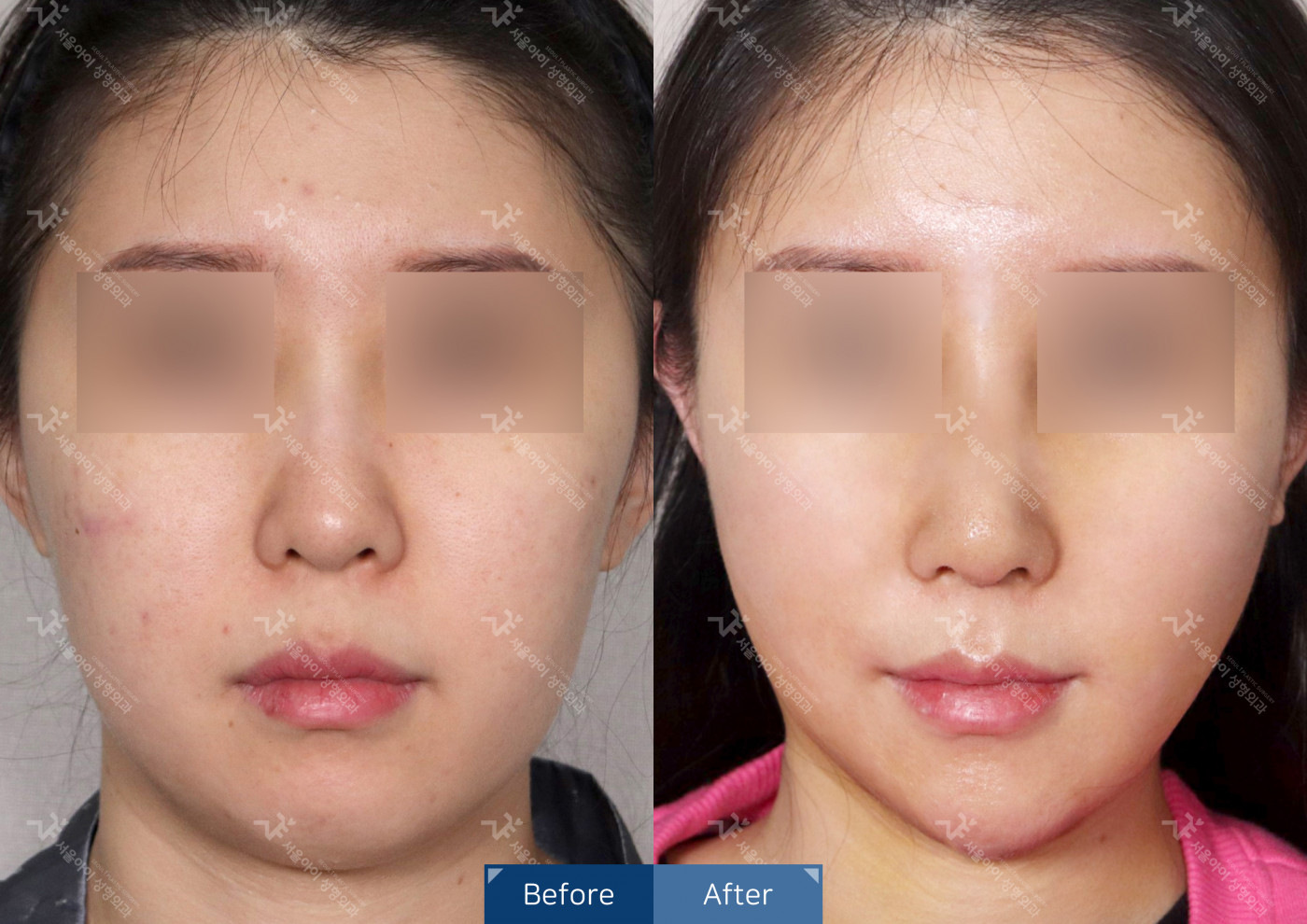 리프팅 [미니리프팅+얼굴지방흡입]