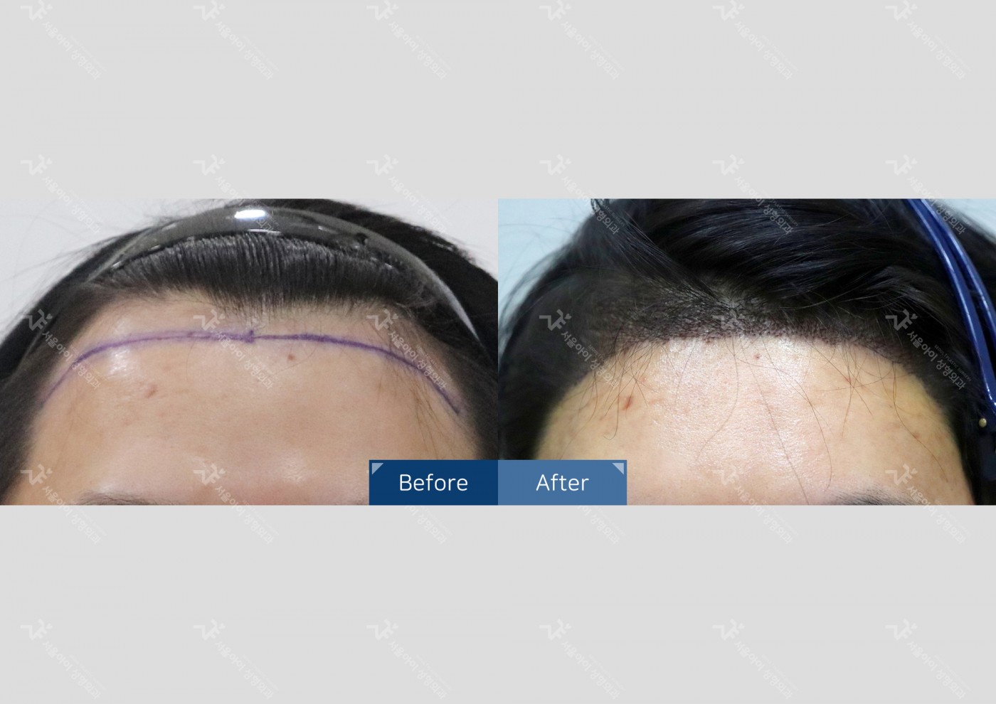 모발이식 [절개 모발이식(4000모)]