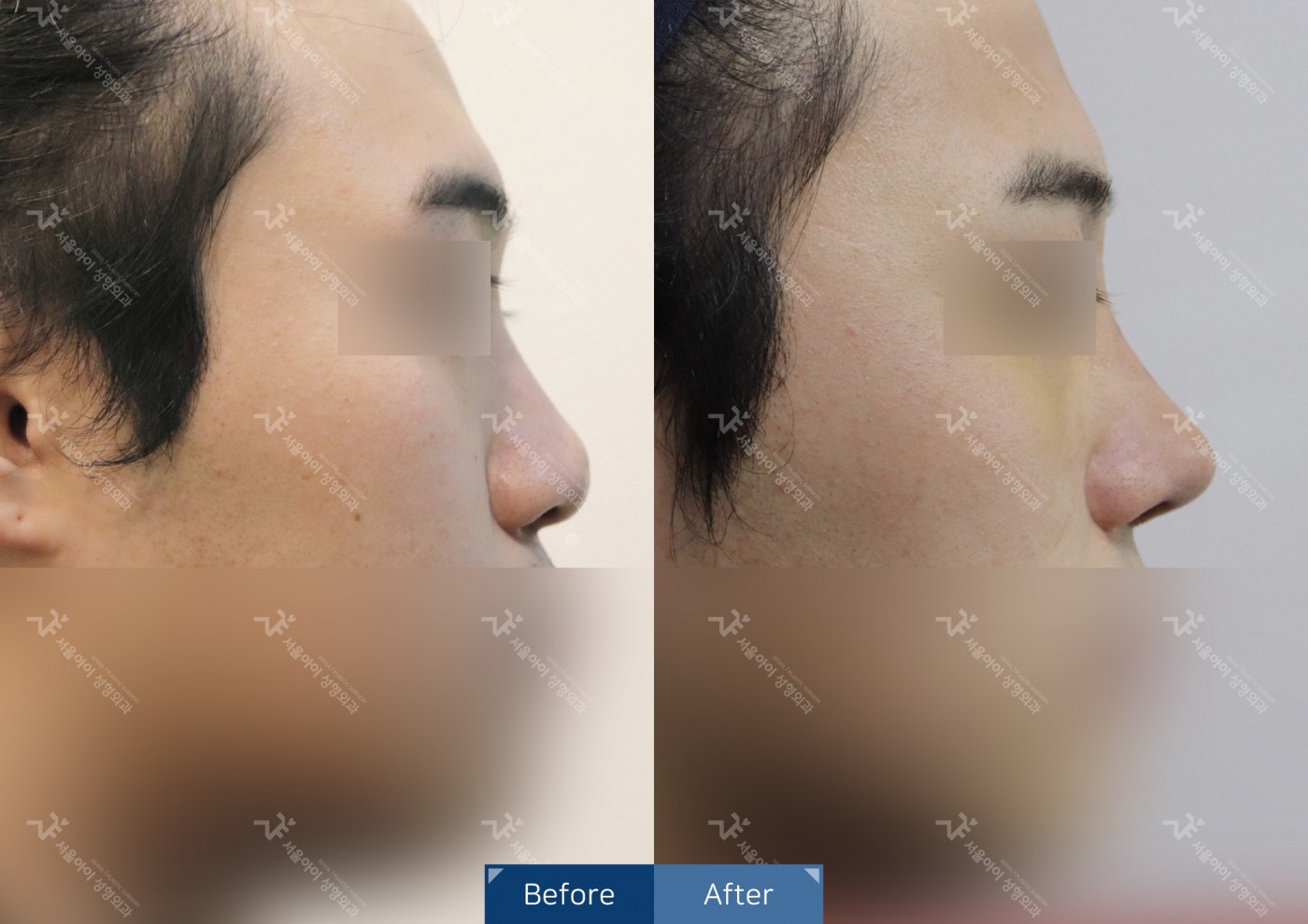코성형 [융비술&코끝조각술(비중격),복코교정]