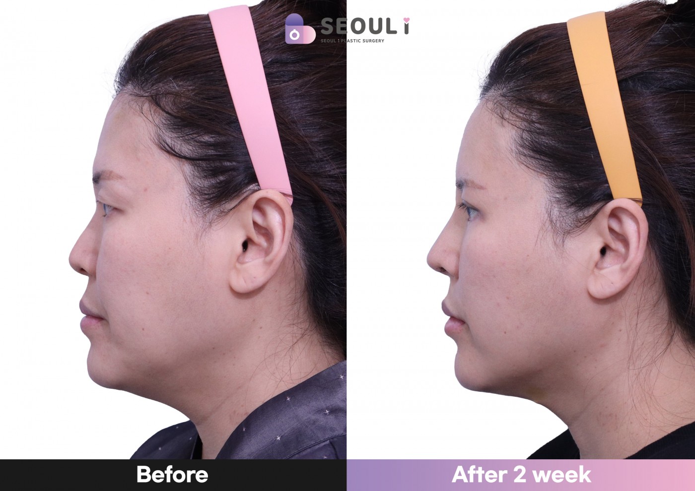 코끝(비중격) + 복코 교정 + 매부리 교정