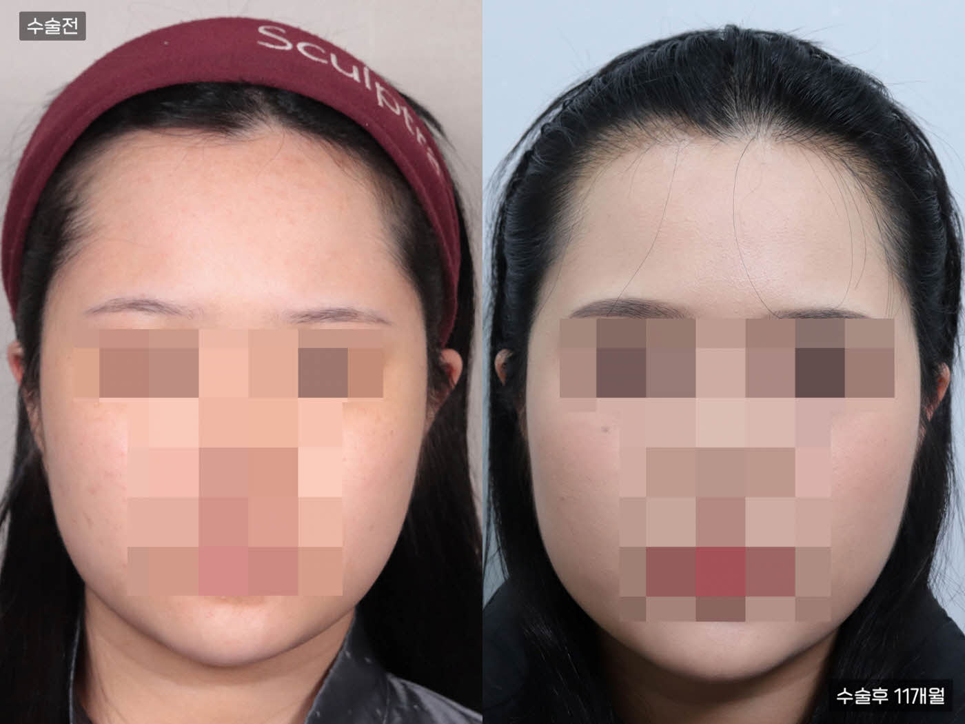 모발이식[절개 모발이식(3000모)]