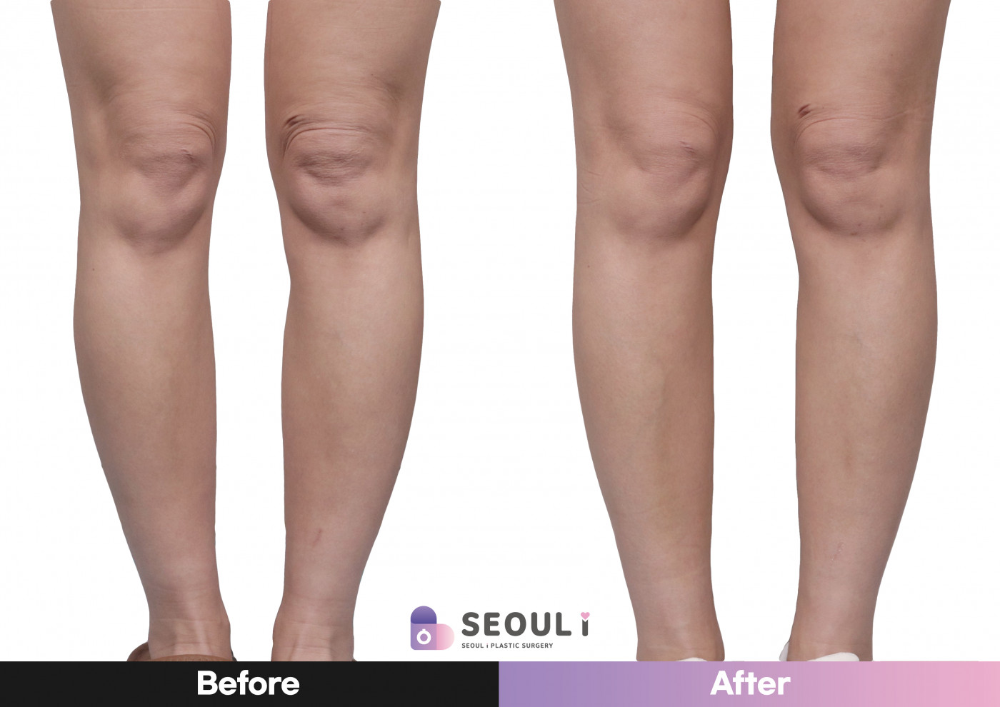 종아리 지방흡입