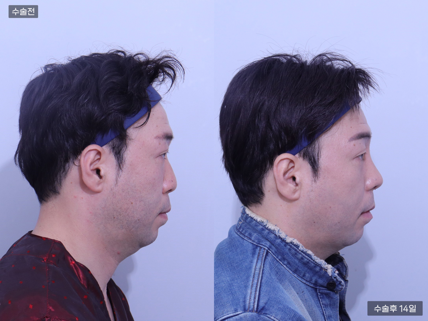 코끝(비중격) + 복코 + 매부리코 + 콧볼축소