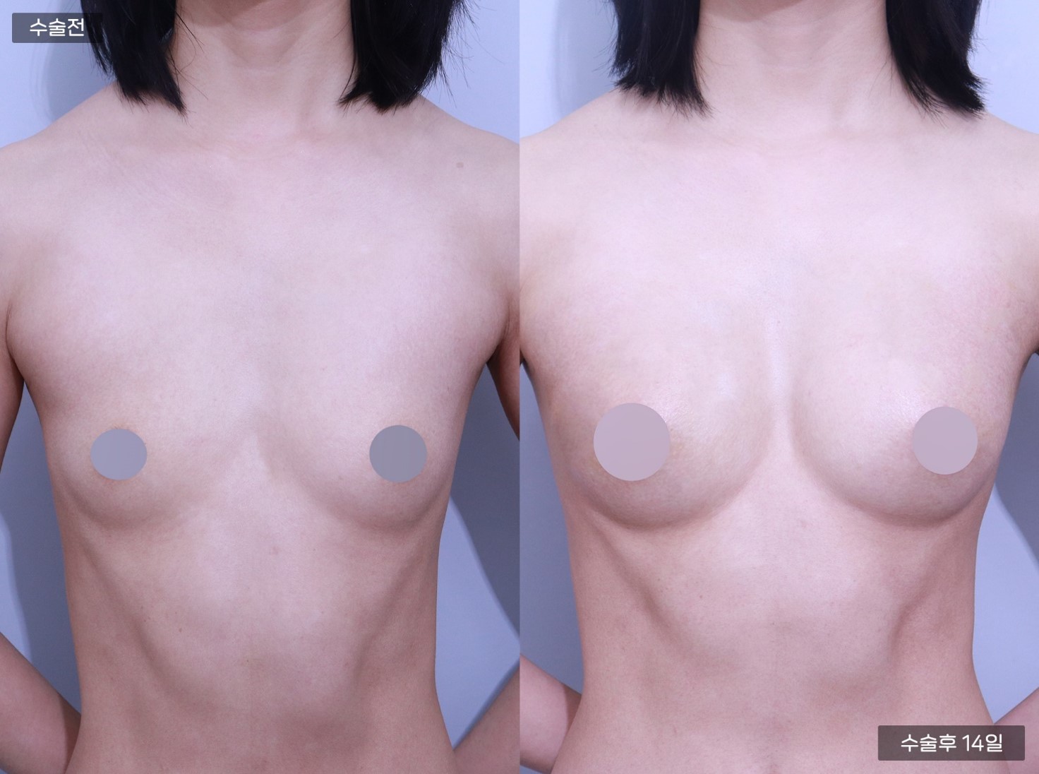 PRP가슴지방이식 (200CC + 200CC)