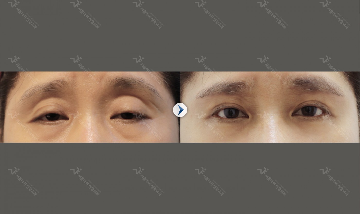 눈성형 [눈썹하거상술 + 자연유착 + 안검하수]