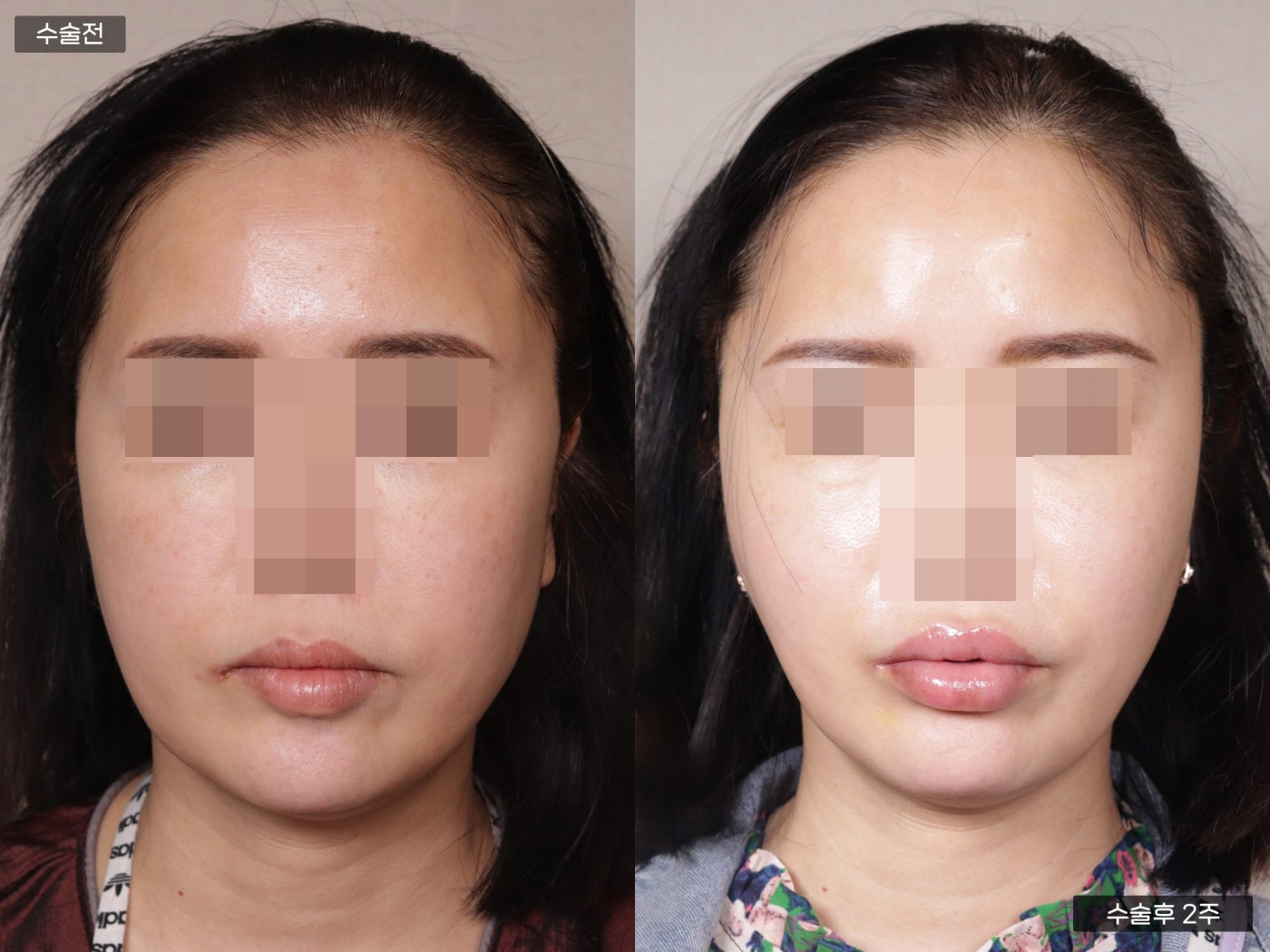 리프팅 [관자거상]