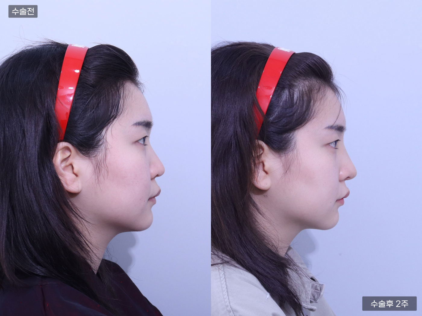 콧볼축소 + 복고 + 매부리코