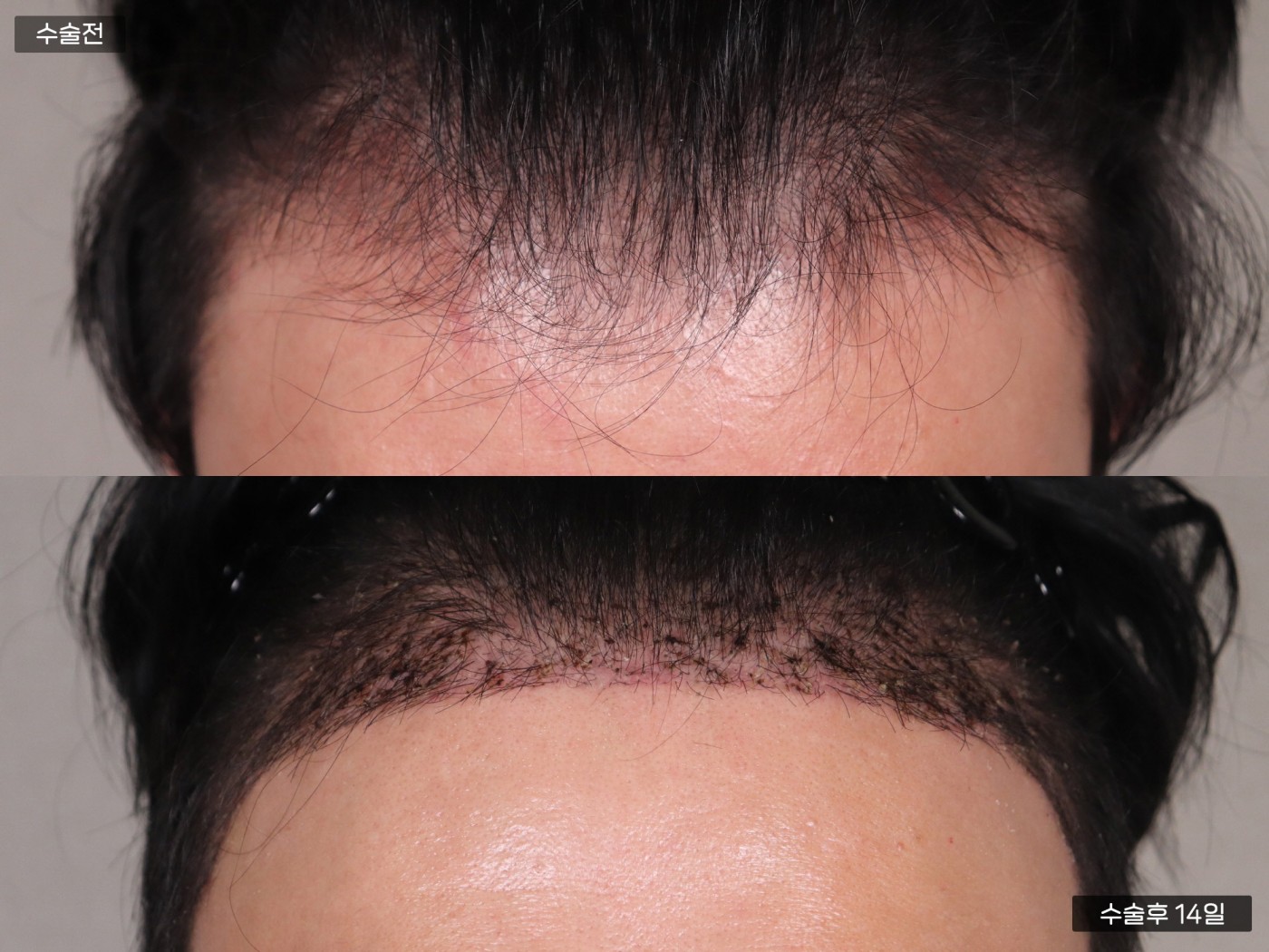 모발이식 [절개 모발이식(4000모)]