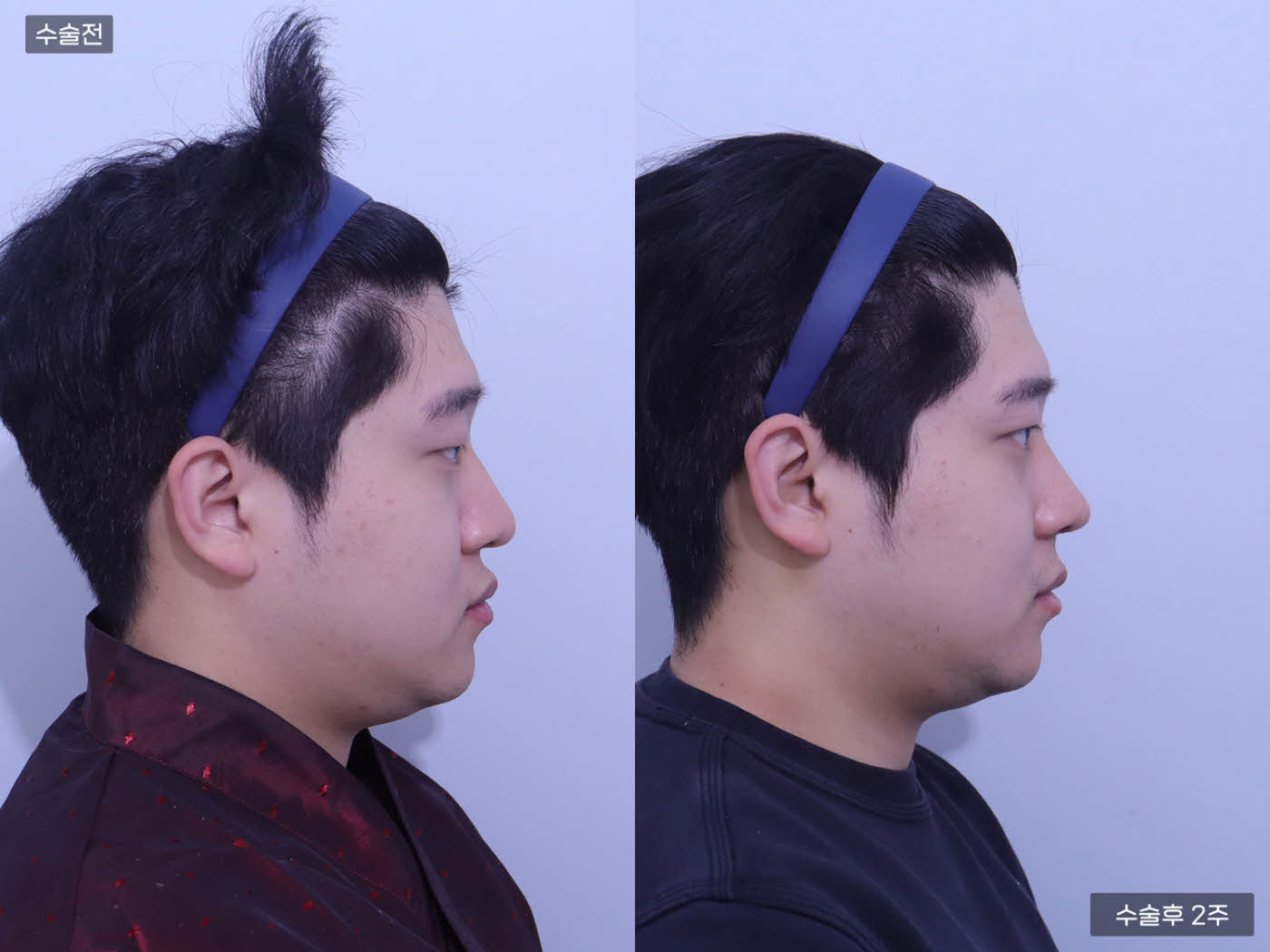 코끝 + 복코 + 매부리코 + 콧볼축소 + 눈매교정 + 앞트임