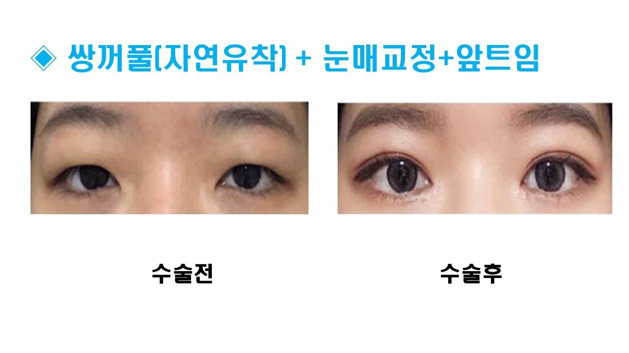 눈성형 [쌍꺼풀 + 눈매교정 + 앞트임]