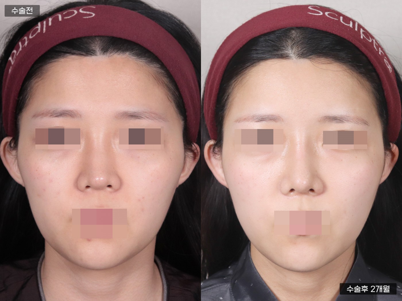 지방이식 [이마]