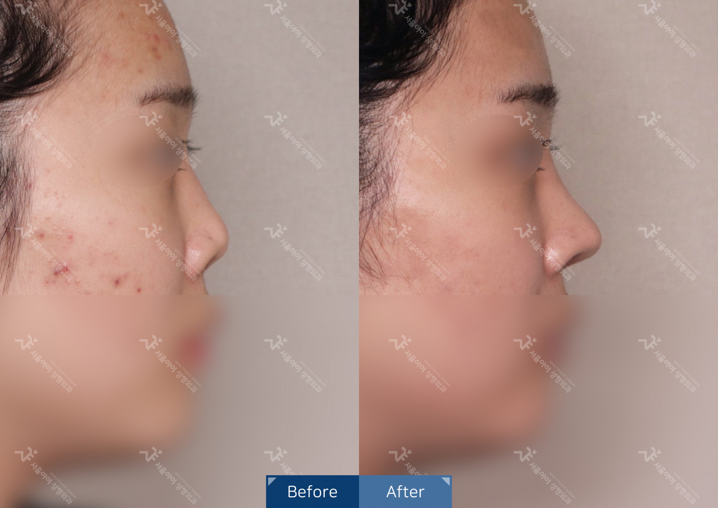 코성형[융비술&코끝조각술(비중격)+메부리+귀연골]