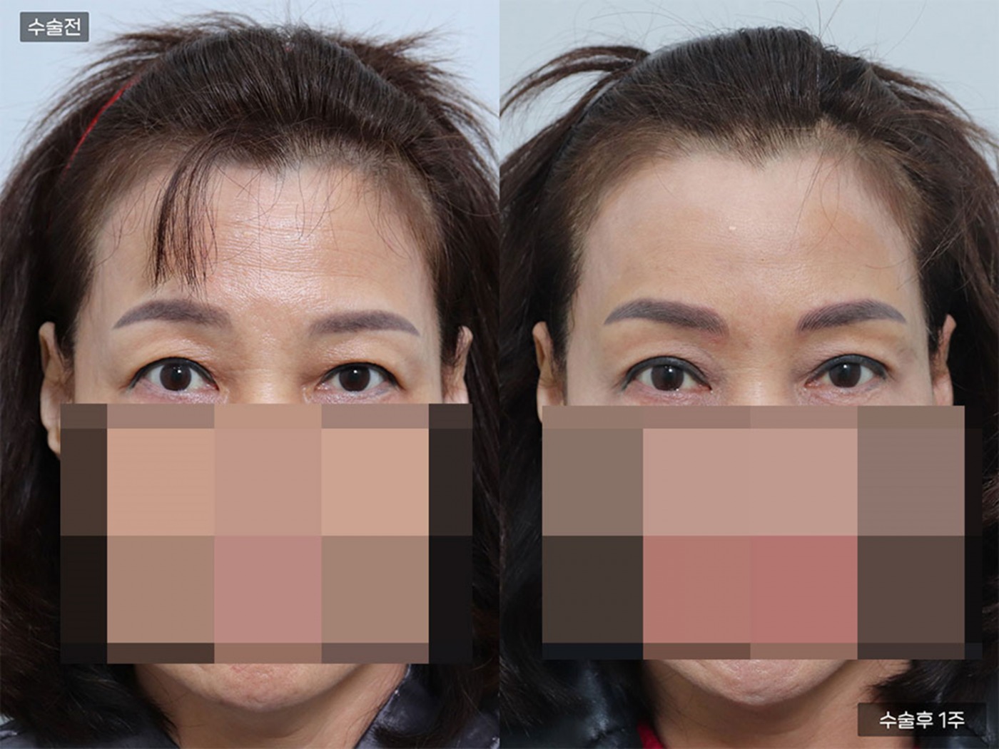 리프팅 [이마거상]