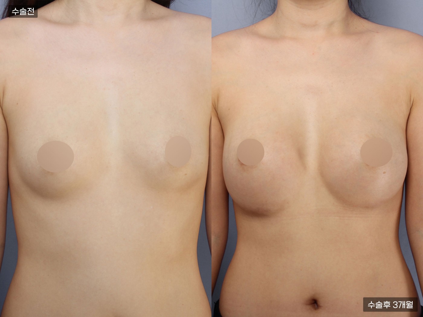 가슴성형 [내추럴가슴보형물]