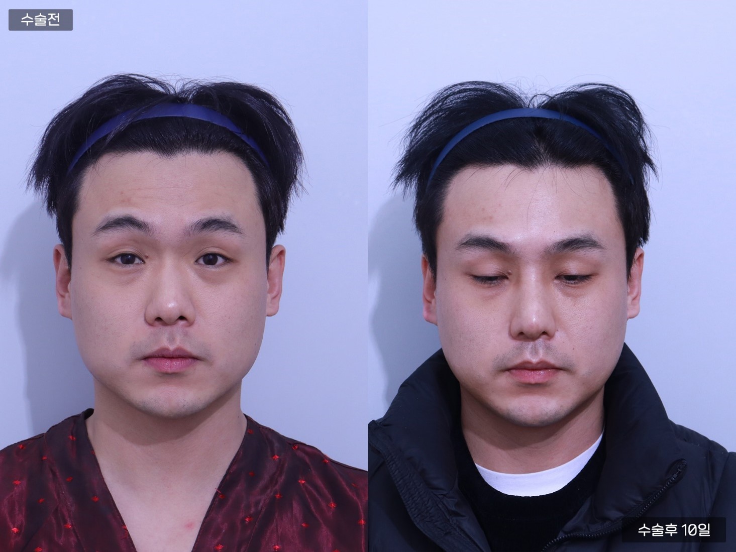 코끝교정 + 복코교정