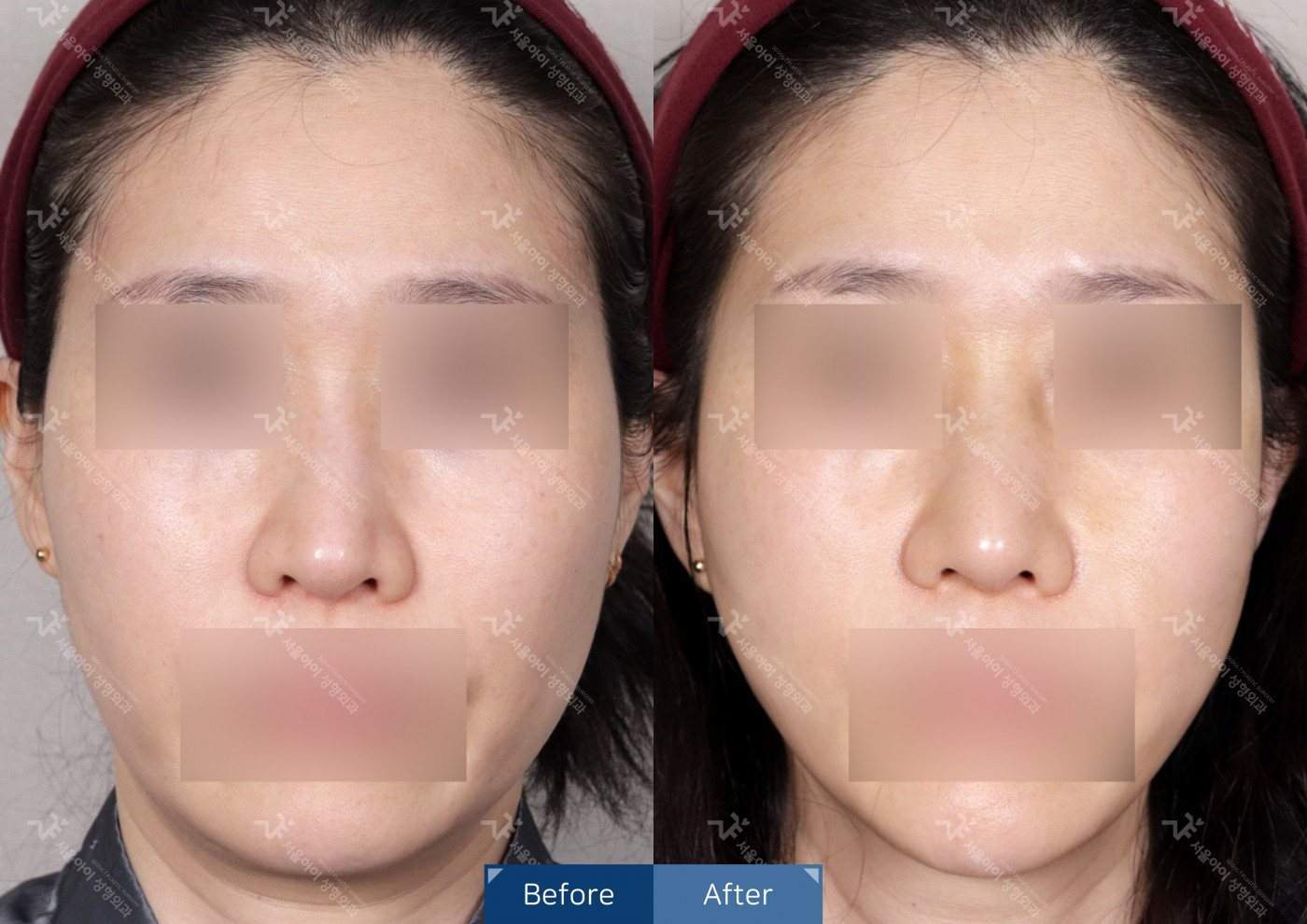 리프팅 [미니리프팅 + 사각턱보톡스]