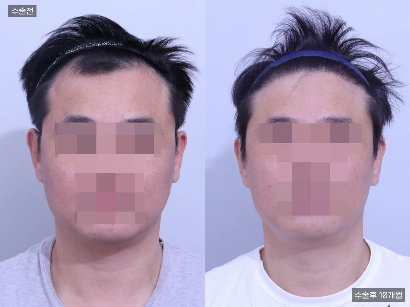 모발이식[절개 모발이식(6000모)]