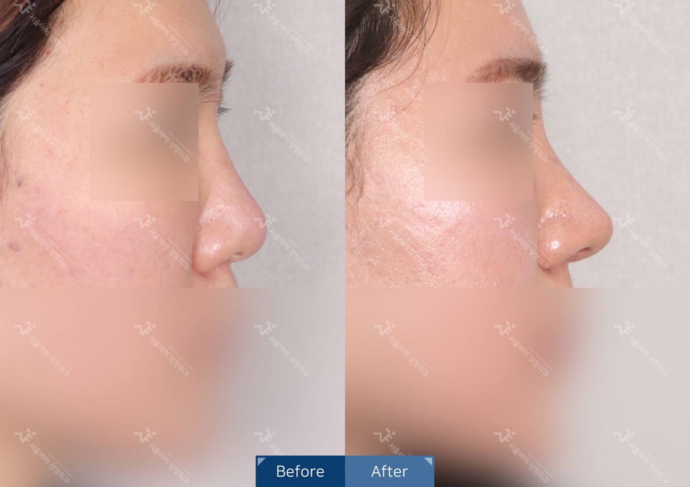 코성형 [코끝조각술(비중격)+복코교정]