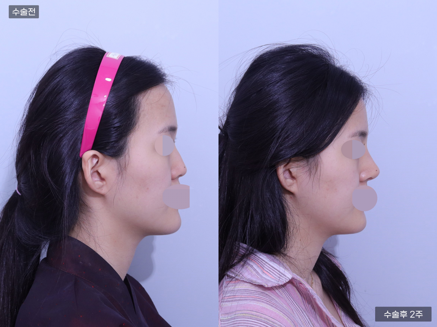 코끝(비중격) + 복코 + 매부리코