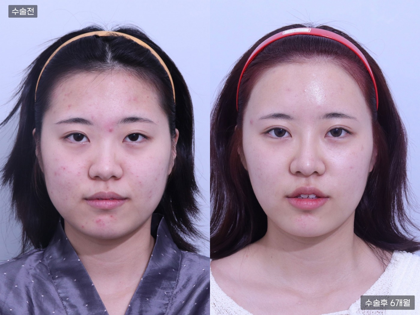 지방이식 [이마]