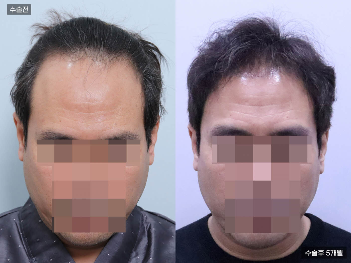 모발이식[절개 모발이식(5000모)]