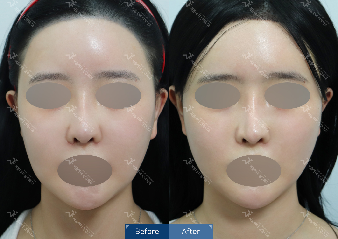 리프팅 [미니리프팅]