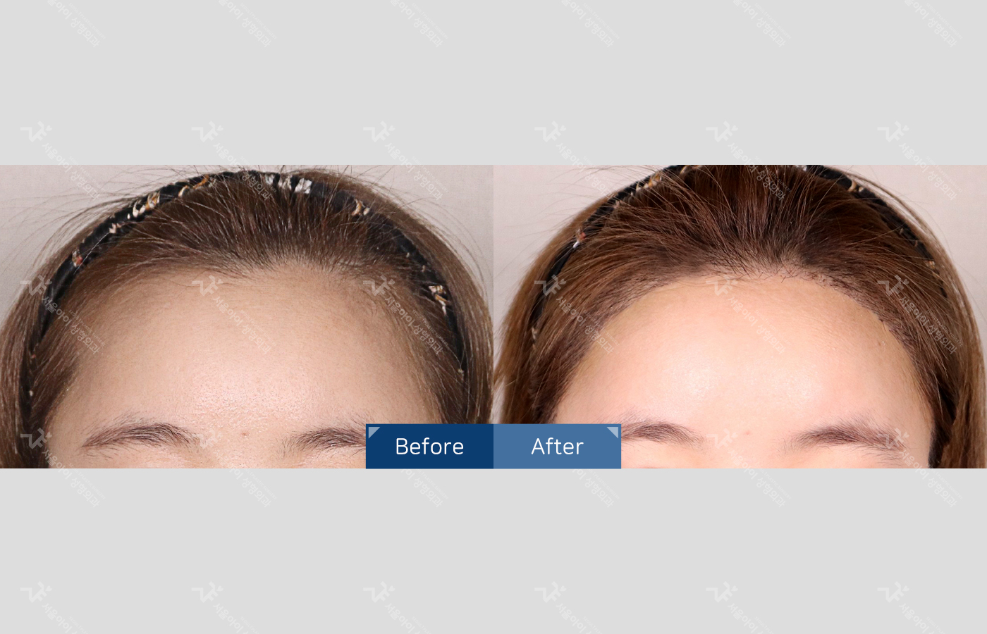 모발이식 [절개 모발이식(4000모) + 헤어라인 + 엠자]