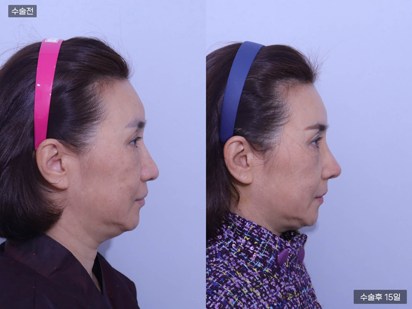 코끝 + 복코 + 매부리코 + 콧볼축소