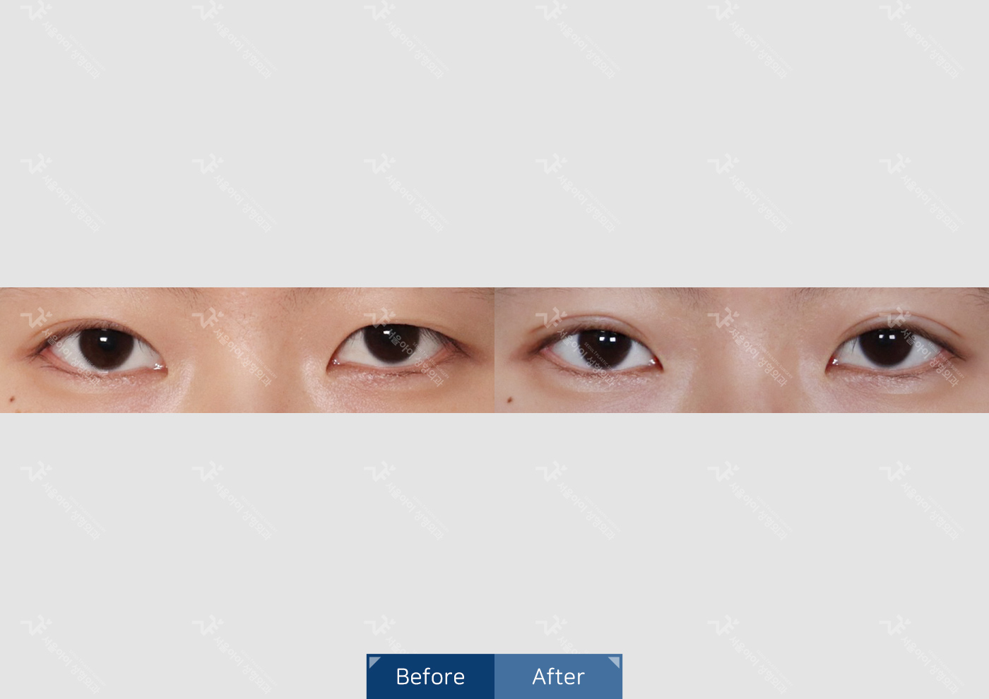 눈성형 [자연유착 쌍꺼풀 + 눈매요정]