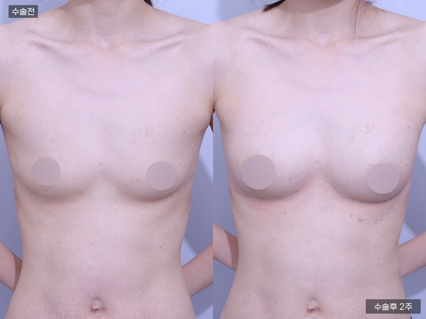 가슴성형 [가슴지방이식(200CC + 200CC)]